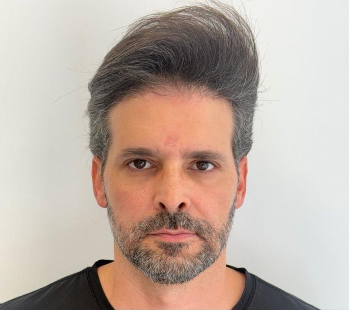 resultado masculino, vista frontal, antes do tratamento