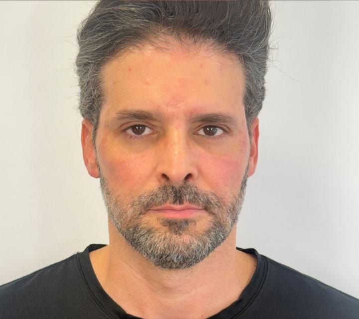 resultado masculino, vista frontal, depois do tratamento