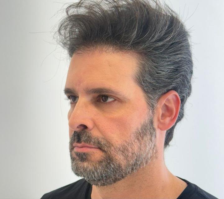 resultado masculino, vista lateral, antes do tratamento