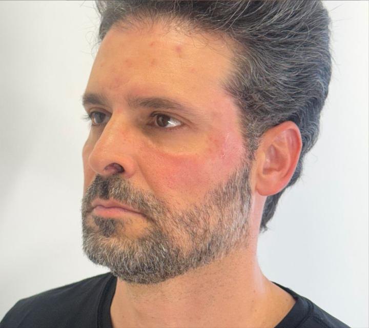 resultado masculino, vista lateral, depois do tratamento