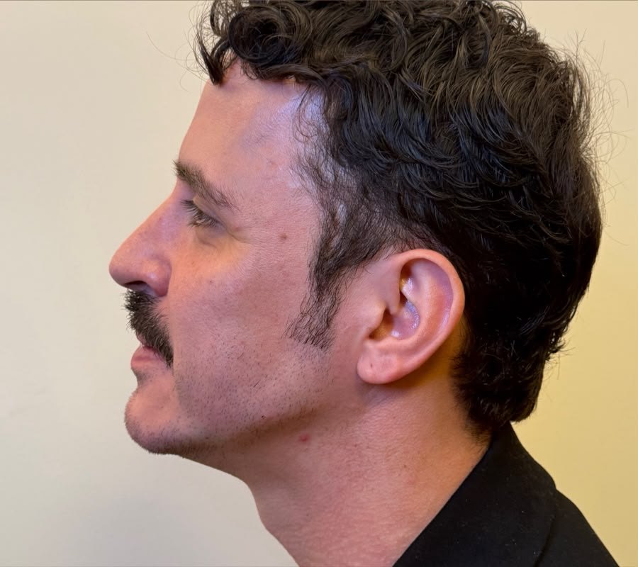 resultado masculino, perfil, depois do tratamento