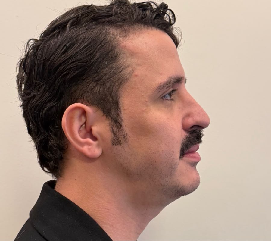 resultado masculino, perfil, antes do tratamento