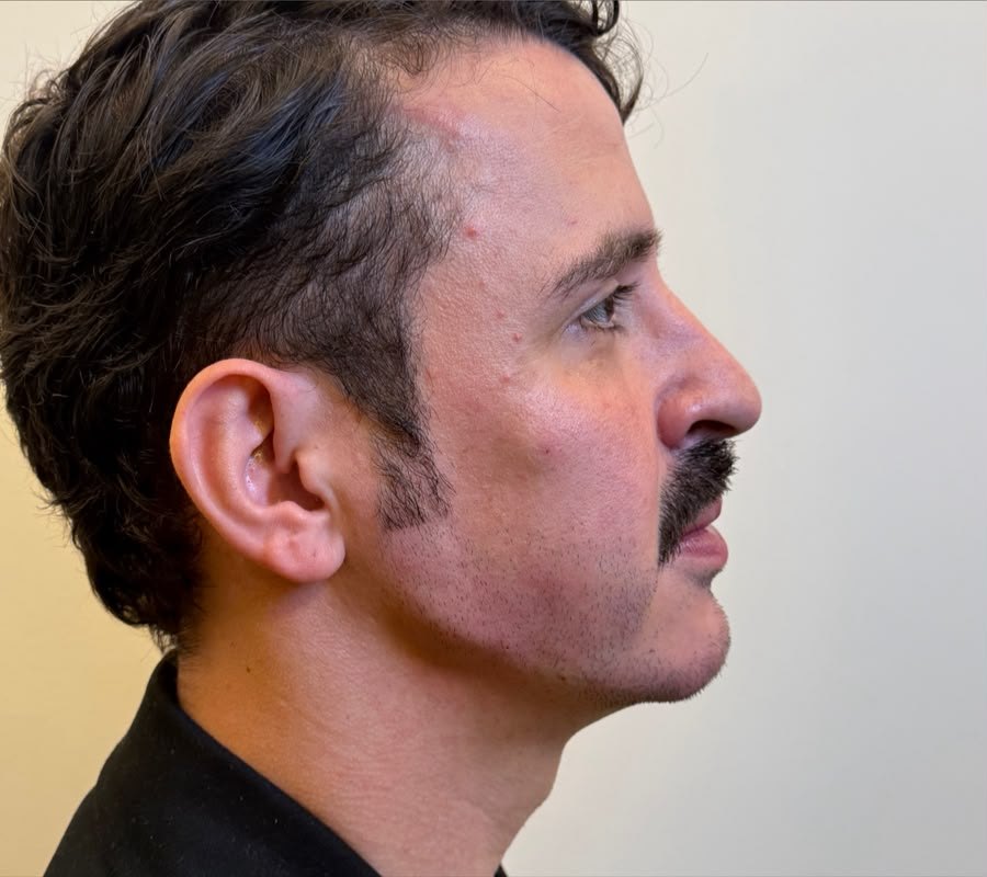 resultado masculino, perfil, depois do tratamento