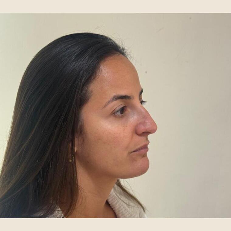 Contorno mandibular antes do tratamento
