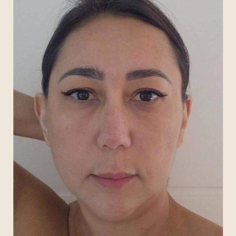Terço médio depois do tratamento